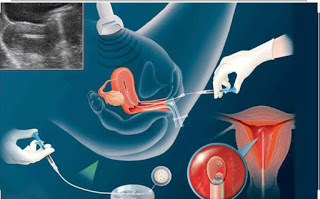 Intrauterine insemination (IUI) is a fertility treatment where sperm are placed directly into a woman’s uterus.